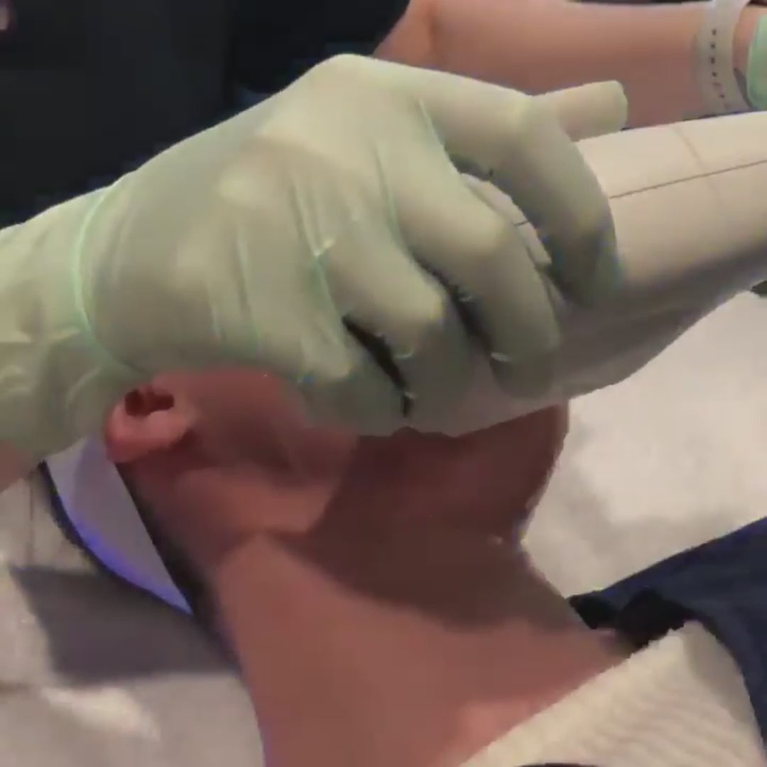 woman getting bbl broadband ipl treatment for acne and brown spots