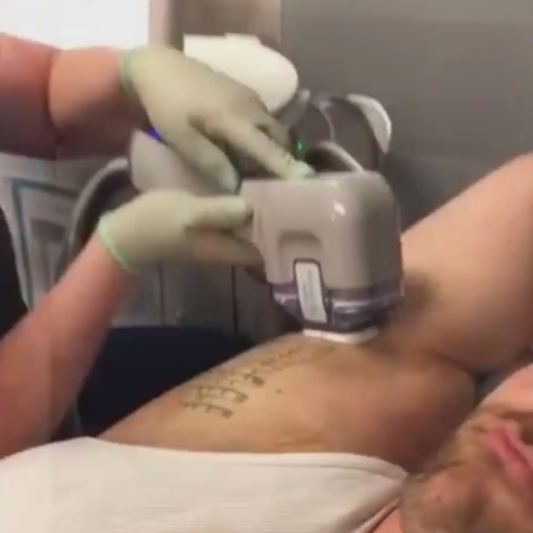 Man getting miraDry treatment for underarm sweat and odor